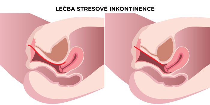 Léčba stresové inkontinence