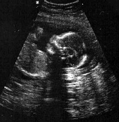 obrázek Ultrazvuk plodu