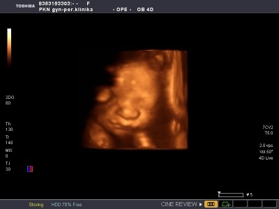 obrázek 3D ultrazvuk