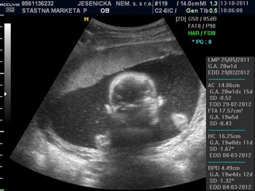 9 týden těhotenství ultrazvuk 2019
