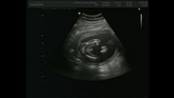 video 3D a 2D ultrazvuk v 19. týdnu těhotenství - pohlaví kluk