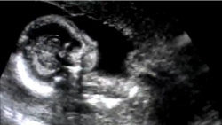video Ultrazvuk ve 20. tt - pohlaví holčička